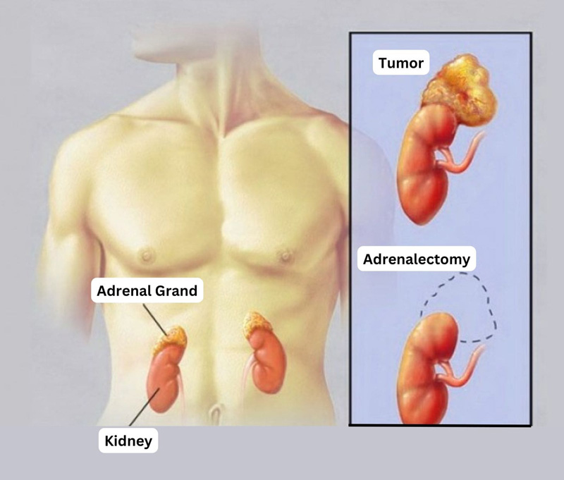 Adrenal cancer treatment showing adrenalectomy procedure and kidney anatomy