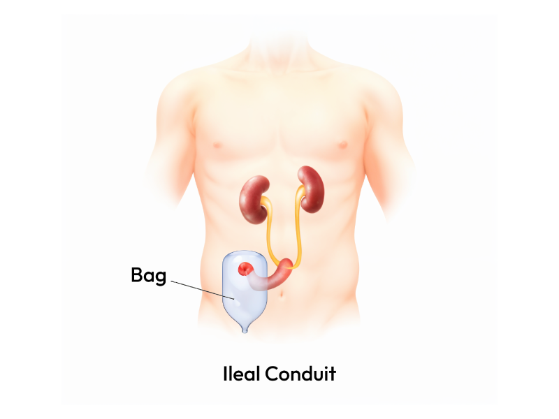 Showcasing the human anatomy with Ileal Conduit