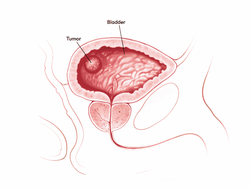 Showcasing the Bladder Cancer