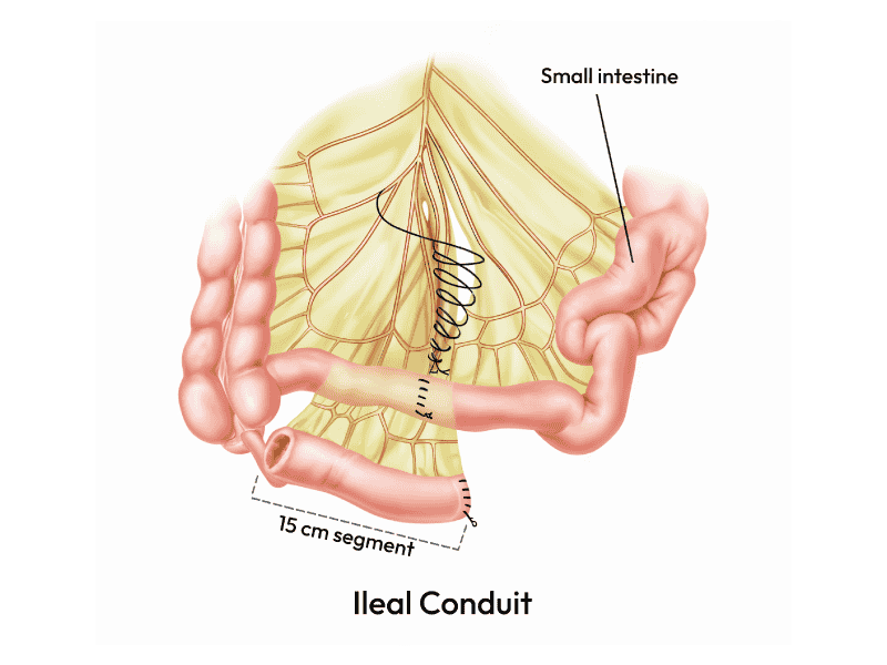 Showcasing the Ileal Conduit