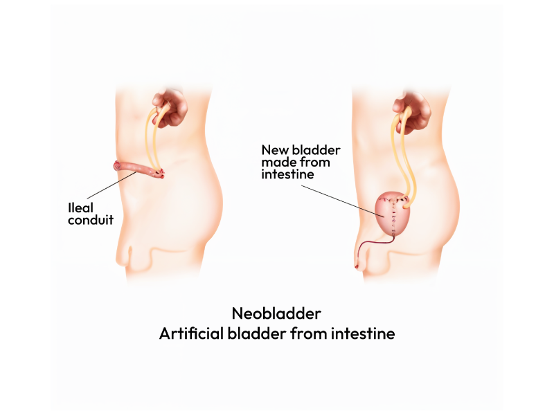 Showcasing the Neobladder with artificial bladder from intestine.