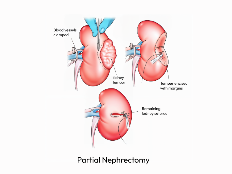 Showcasing the Partial Nephrectomy