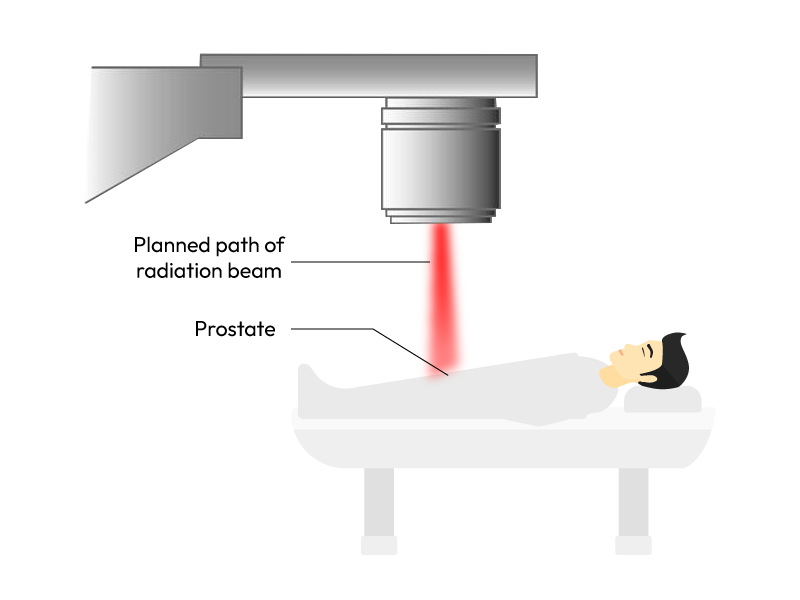 Showcasing Prostate Cancer Radiotherapy