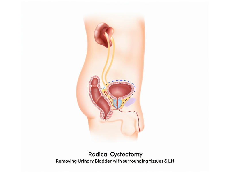 Showcasing the Radical Cystectomy.