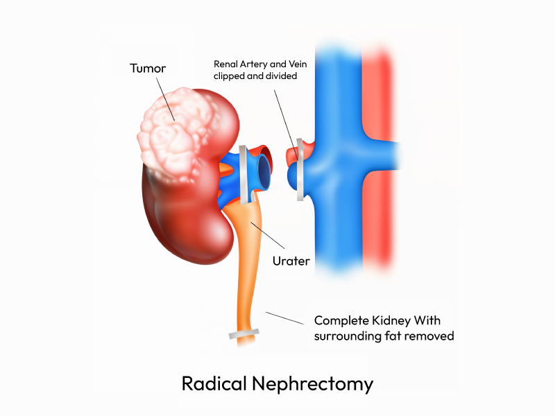 Showcasing the Radical Nephrectomy