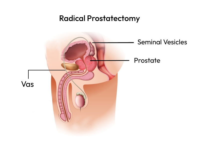 Showcasing Radical Prostatectomy with prostate cancer.