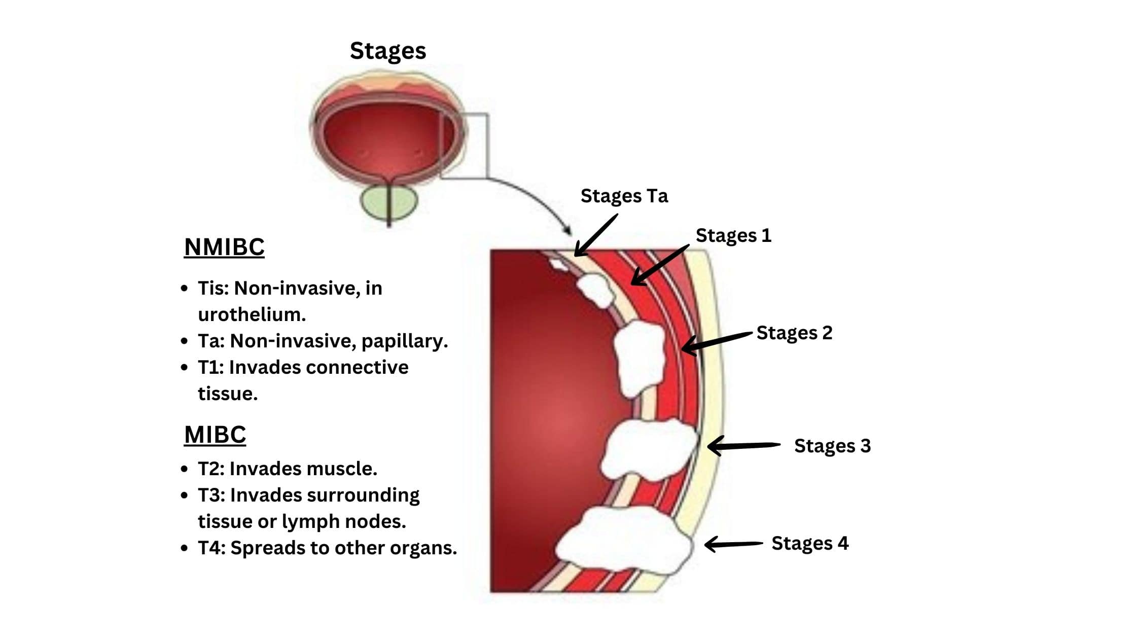 Showcasing the Stages of Bladder Cancer