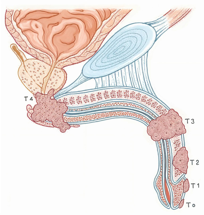 Penile cancer stages from non-invasive Ta to T4