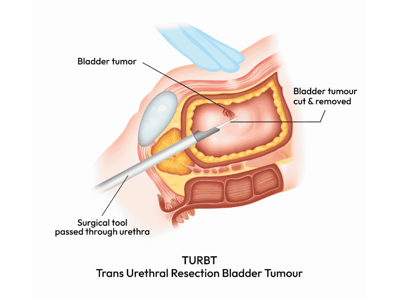 Transurethral Resection of Bladder Tumor