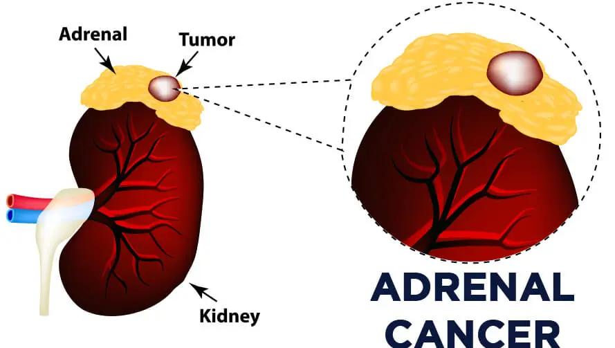 Adrenal-cancer-treatment