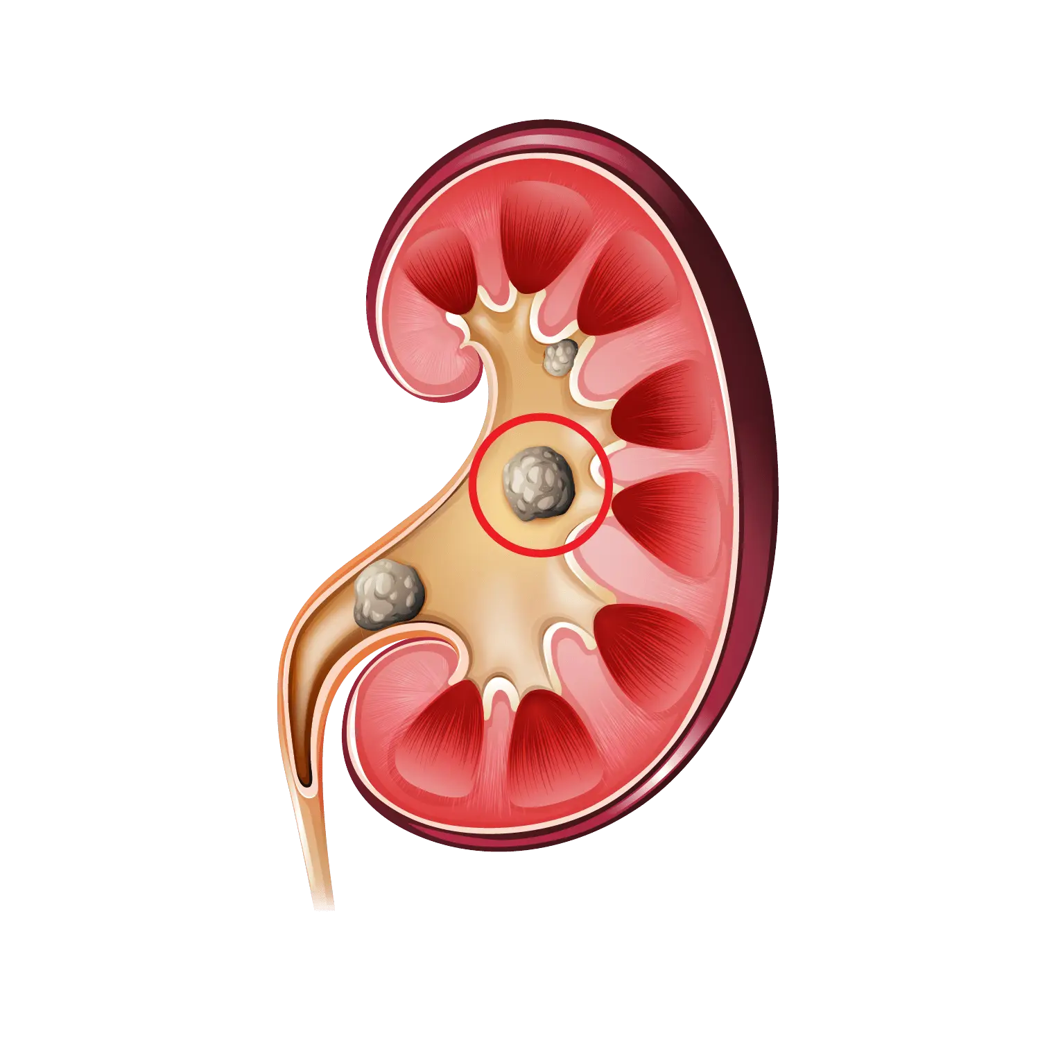 Kidney Stone Treatment