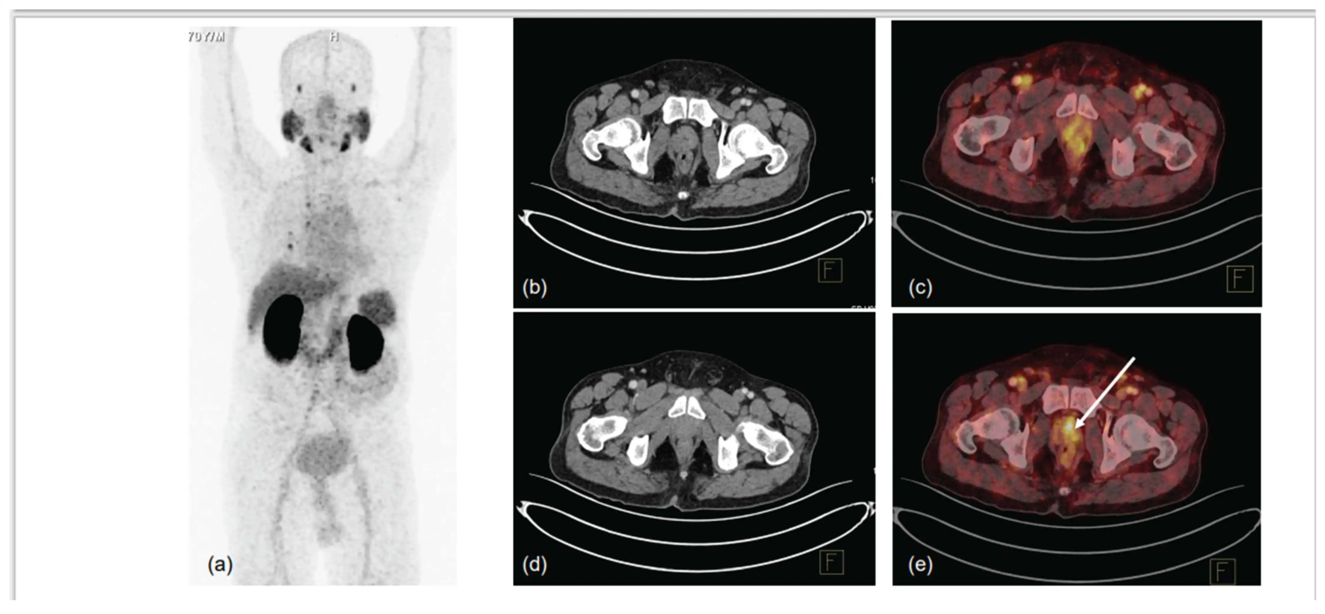 DIAGNOSIS OF PROSTATE CANCER