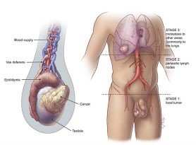 STAGES OF TESTIS CANCER