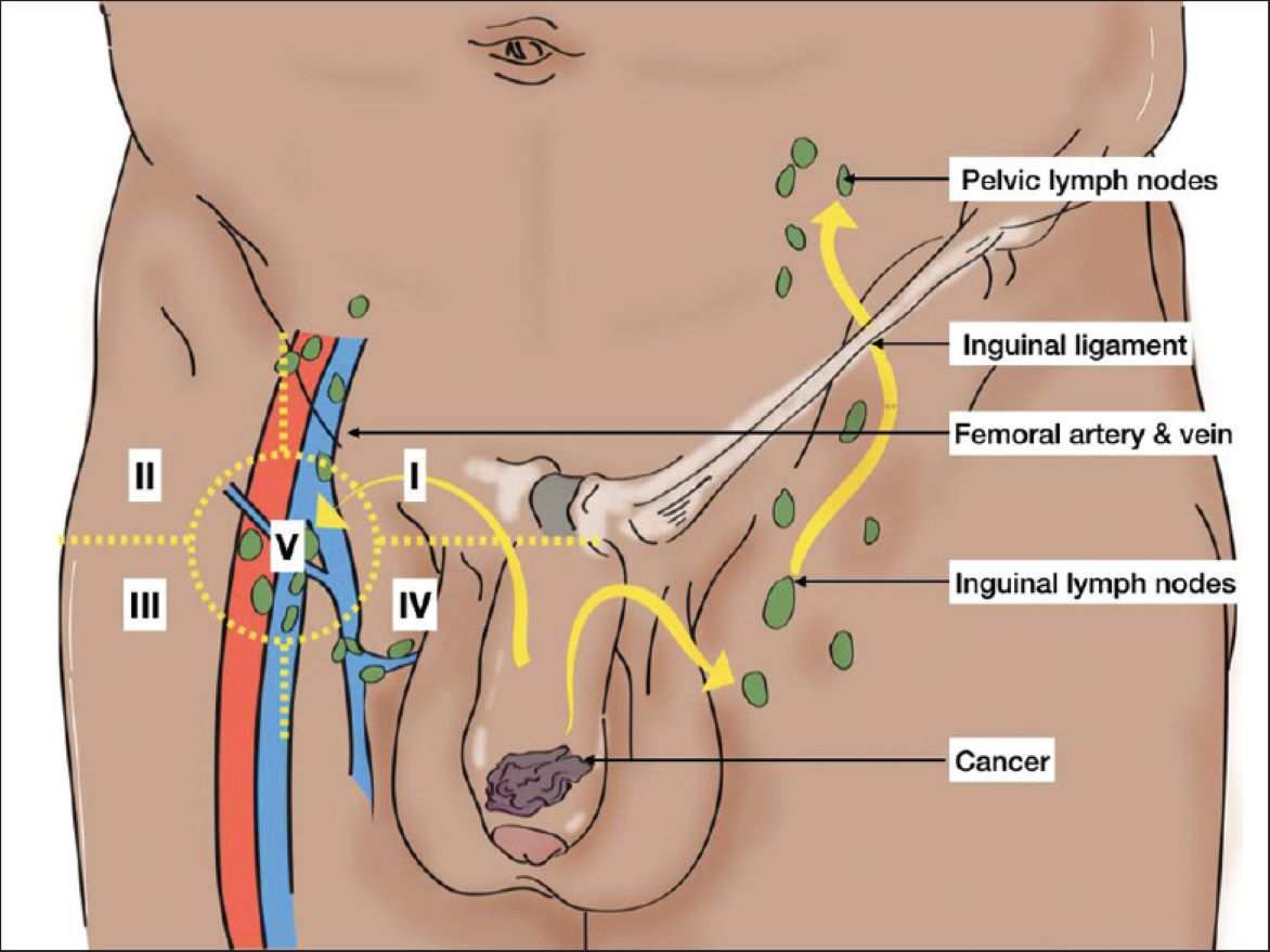 Penile Cancer