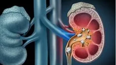 Recent Advances in Kidney Cancer Treatment