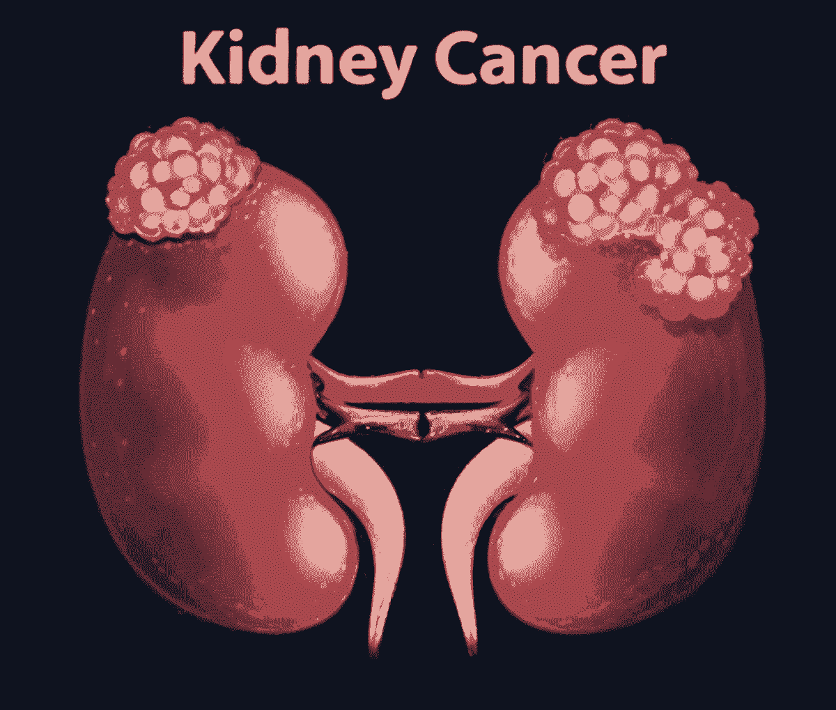 Kidney Cancer