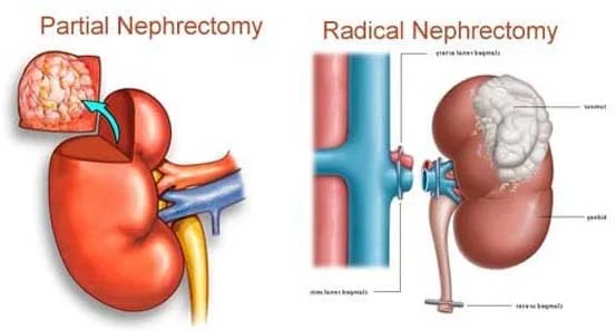 Recent Advances in Kidney Cancer Treatment