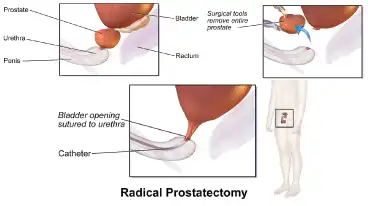 radical prostatectomy