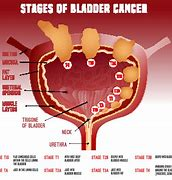 Recent Advances in Kidney Cancer Treatment