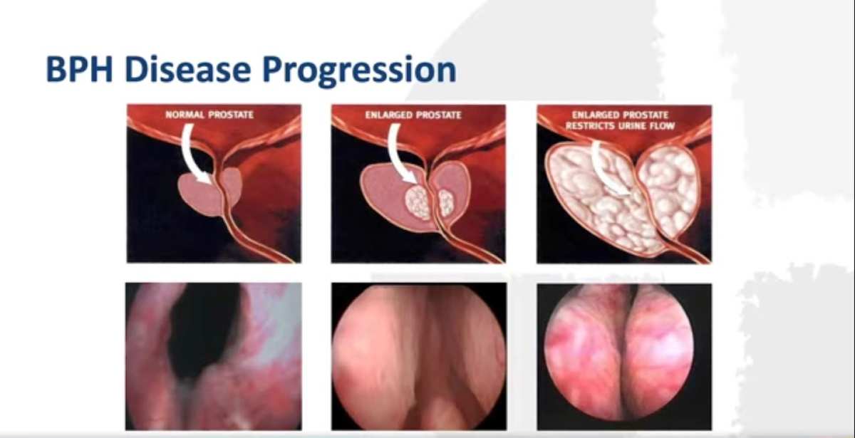 bph-Symptoms 