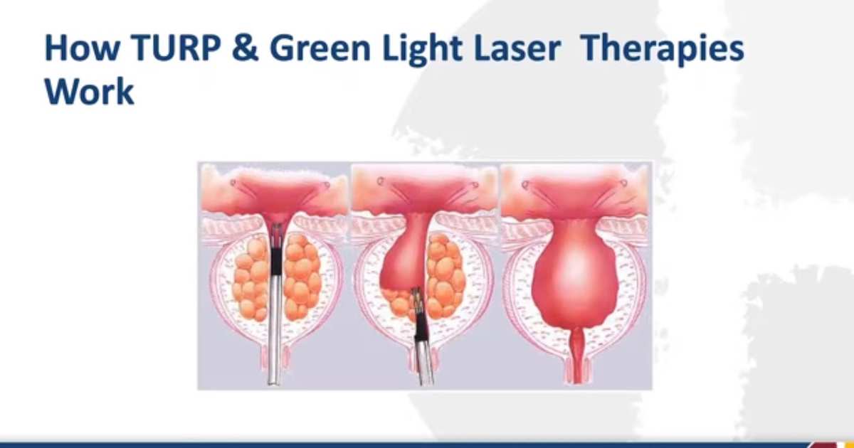 Bipolar TURP